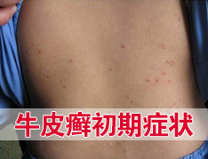 银屑病常见的症状都有哪些