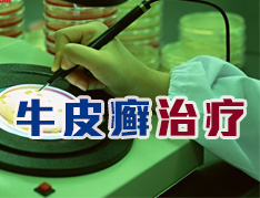 治疗牛皮癣应注意什么